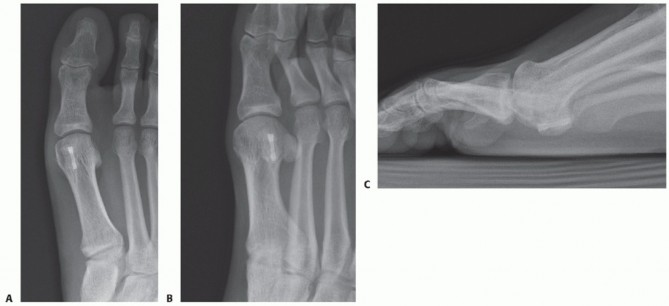 Illustration 28 for Optimizing Internal Fixation of Sesamoid Fractures