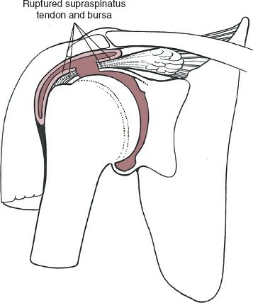 Illustration 147 for Essential Guide: Mastering Every Approach to the Shoulder