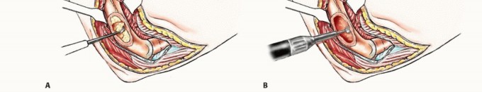 Illustration 41 for Restore Vital Function: Surgery for Type II Humeral Metastasis