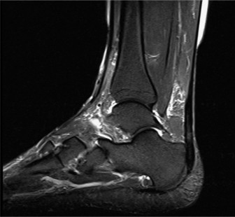 Illustration 2 for Beat Achilles Pain: How Eccentric Calf Stretching Provides Relief.