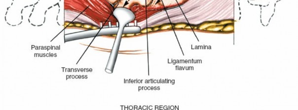 Illustration 357 for Approach to the Lumbar Spine: Mastering Techniques & Anatomy