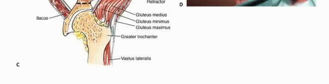 Illustration 18 for Pelvic Metastasis Surgery: A Component of the Utilitarian Approach