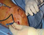 Illustration 8 for Microfracture Chondroplasty: How Tiny Holes Are Made to Fix Cartilage