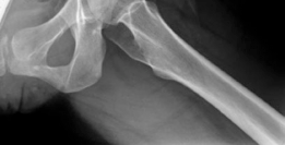 Illustration 4 for Open Hip Dislocation: How Fascia Lata Autograft Restores Stability