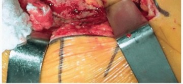 Illustration 5 for Unlock Precision: The Direct Lateral Approach for THA