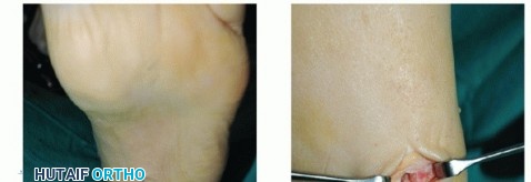 Illustration 56 for Restore Movement: Tendon Transfer for Common Peroneal Nerve Foot Drop