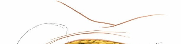 Illustration 126 for Pelvis & Acetabulum Approaches: Unlocking the Posterior Superior Iliac