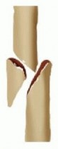 Illustration 10 for Advanced Nailing of the Mature Tibia: Overcoming Complexities