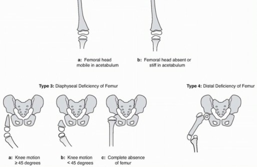Illustration 2 for Treatment for Congenital Femoral Deficiency: What You Need to Know