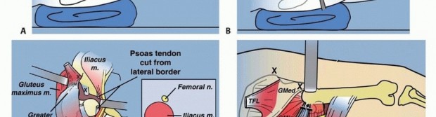 Illustration 18 for Treatment for Congenital Femoral Deficiency: What You Need to Know
