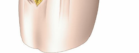 Illustration 23 for Surgical Access: Mastering the Tibia's Surface & Fibula Approaches