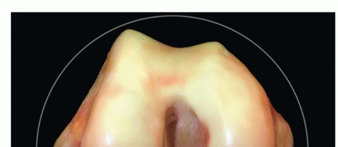 Illustration of doublebundle acl reconstruction - Dr. Mohammed Hutaif