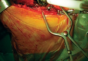 Illustration 49 for Cemented Component Longevity: The Critical Margin of the Acetabulum