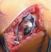 Illustration 29 for Knee Arthroplasty Unicondylar: Discover if Partial Knee Replacement is Right