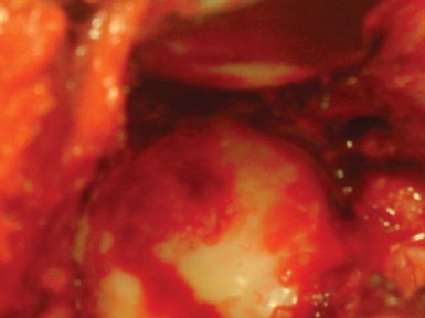 Illustration 18 for Total Hip Arthroplasty: Restoring Mobility in Juvenile Idiopathic Arthritis
