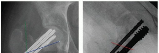 صورة طبية: جراحة قطع العظم حول الحُق وقطع عظم الفخذ: إعادة محاذاة مفصل الورك لراحة دائمة مع الأستاذ الدكتور محمد هطيف