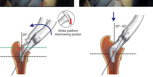 Illustration 9 for The Proxima: Why This Proximally Loading Implant Preserves Bone