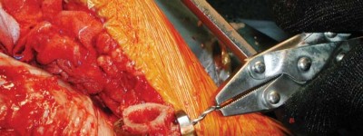 Illustration 86 for S-ROM: Inside the Technique of Modular Implant Design