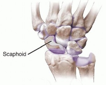 Volar Wedge Bone Grafting and Internal Fixation of Scaphoid Nonunions