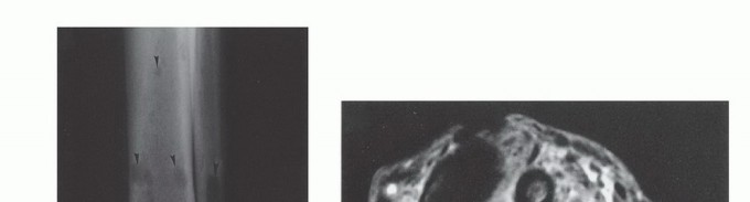 Illustration 6 for Below-Knee Amputation: Maximize Your Below-Knee Recovery & Function