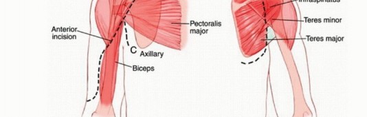 Illustration 21 for Limb-Sparing Resections Around the Shoulder: Optimizing Outcomes
