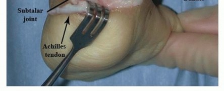 Illustration 9 for Resistant Clubfoot Solved: Posteromedial and Posterolateral Release