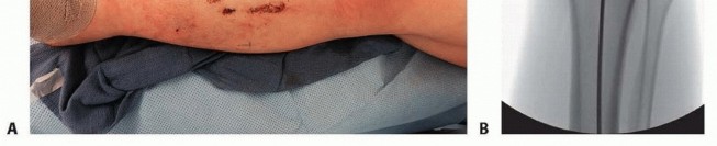 Illustration 19 for Optimizing Intramedullary Nailing for Tibial Shaft Fractures