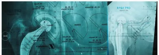 مراجعة مفصل الورك بالإسمنت داخل الإسمنت: حلول متقدمة لعمليات استبدال الورك المعقدة مع الأستاذ الدكتور محمد هطيف