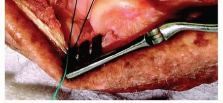 Illustration 19 for Restore Stability & Motion: Fixation of Fracture-Dislocations