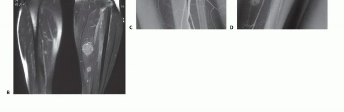 Illustration 9 for Precision Biopsy of Musculoskeletal Tumors for Accurate Diagnosis