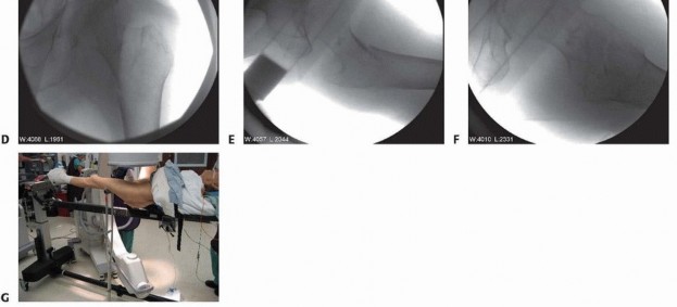 Illustration 12 for ORIF for Peritrochanteric Hip Fractures: Achieve Stable Mobility