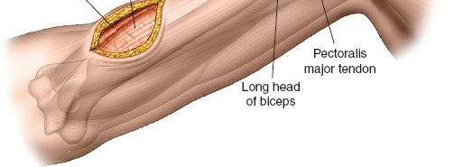 Illustration 24 for Mastering the Approach to the Distal Humerus: Safety & Skills