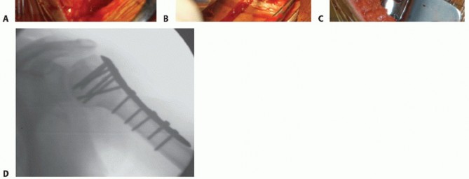 Illustration 22 for Optimizing Fixation of Proximal Humerus Fractures: A Guide