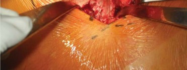 Illustration 90 for Successful Total Hip Replacement in Developmental Dysplasia