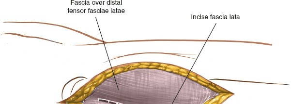 Illustration 5 for Optimal Femoral Approaches: Mastering the Lateral Intermuscular Septum