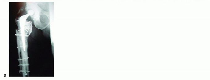 Illustration 11 for Exeter Hip Unit: Mastering Impaction Allografting for Femoral Bone Loss