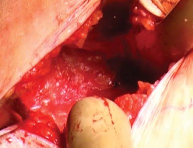 Illustration 5 for Mastering the Anterolateral Approach in Minimally Invasive Hip Replacement