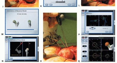 Illustration 29 for Hip Resurfacing: The Bone-Sparing Solution around the Femoral Head