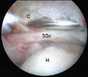 Illustration 20 for Arthroscopic Subscapularis Repair: The lo iky brady Method for Stability
