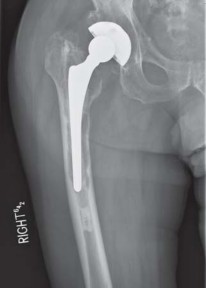 Illustration 15 for THA for patients with proximal femoral deformity: Practical solutions