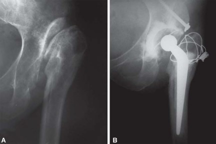 Illustration 35 for Expert Bone Grafting for Primary Total Hip Replacement Success