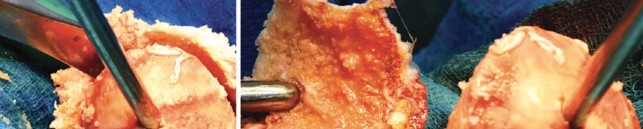 Illustration 84 for Birmingham Hip Resurfacing Designer's Technique for Active Lives