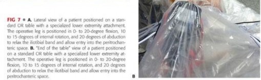 Illustration 92 for Periarticular Arthroscopy: Addressing Medius & Minimus Tears