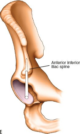 Illustration 32 for Key Approaches for External Fixation: Humerus, Radius, Ulna, Wrist