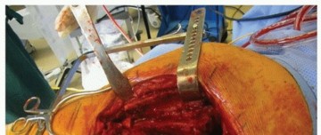 Illustration 17 for Extended Trochanteric Osteotomy: How et al Extended Revision THA Solutions