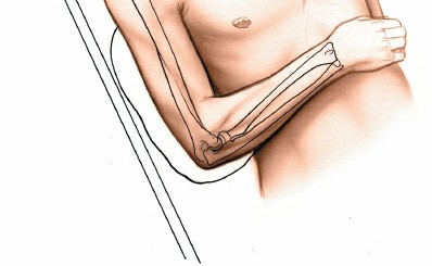 Illustration 2 for Posterior Radius: Expert Tips for Brevis and the Extensor Side