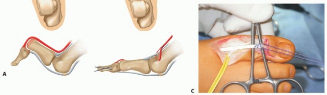 Illustration 25 for How Achilles Tendon Lengthening Fixes Equinocavovarus Foot