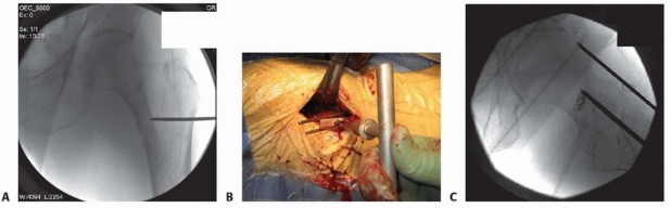 Illustration 13 for ORIF for Peritrochanteric Hip Fractures: Achieve Stable Mobility