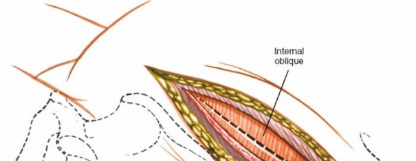 Illustration 11 for Master the Anterolateral Retroperitoneal Approach to Lumbar Spine