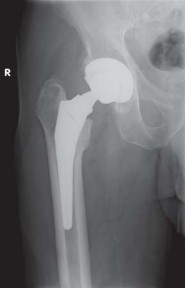Illustration 65 for Kinectiv® Stem: Modular Necks for Primary THA Success